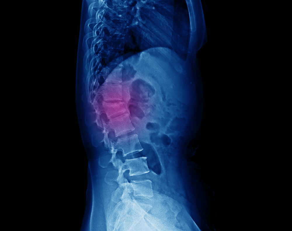 Spinal Decompression